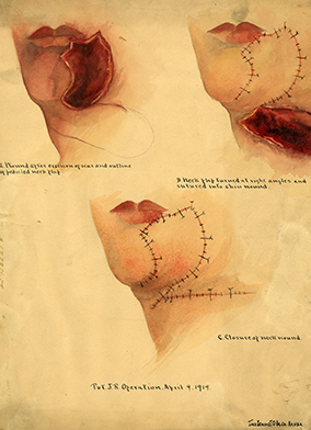 Inez Demonet's depiction of facial reconstruction surgery, 1919. (Source: Wikimedia Commons)