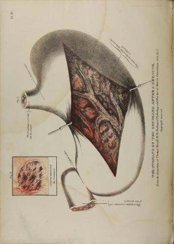 Stomach of a Drunkard (Source: Thomas Sewall's 1841 book, The Pathology of Drunkenness)